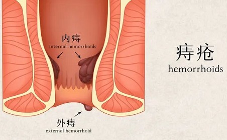 【北京丰益肛肠医院】痔块脱垂不只是难受，说明痔疮加重了！