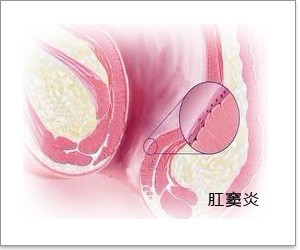 北京肛肠科好的医院 肛窦炎肛肠疾病的“”