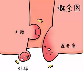 北京的痔疮医院哪家口碑好？怎么知道是内痔?