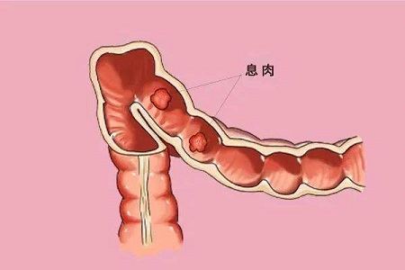 北京市2024年肠癌早筛秋季 肠息肉是什么原因引起的？