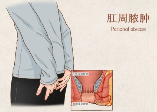 北京肛周脓肿引流术哪家医院做得好？四大原因致使肛周脓肿频发！