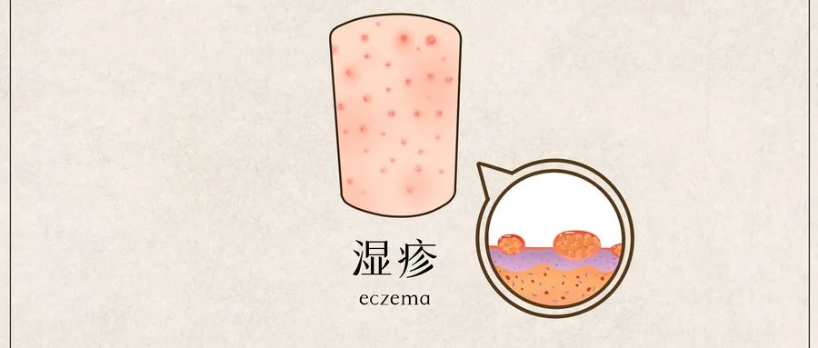 肛周湿疹不等同于普通湿疹，5个常见误区要避免！
