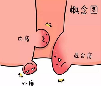 治痔疮北京哪家医院好？这三种类型的痔疮，比较棘手！