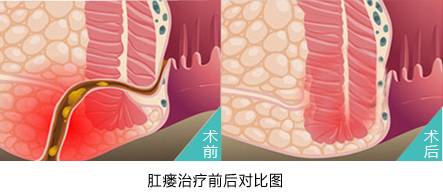 北京肛肠医院肛瘘手术费用？肛瘘为什么反复难治愈？