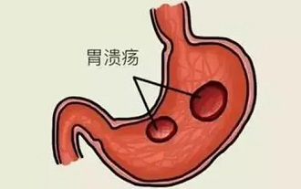 北京消化内科的医院排名榜 胃溃疡的症状有哪些？