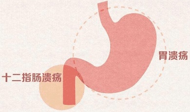什么是十二指肠炎？十二指肠炎有哪些症状表现？