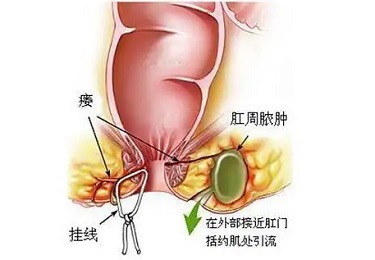 肛周脓肿要及时治疗！拖久了，当心并发症！