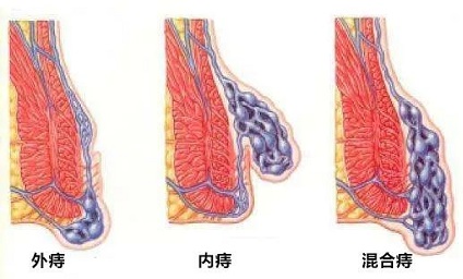 北京治痔疮好的医院 如何区分痔疮和直肠脱垂？