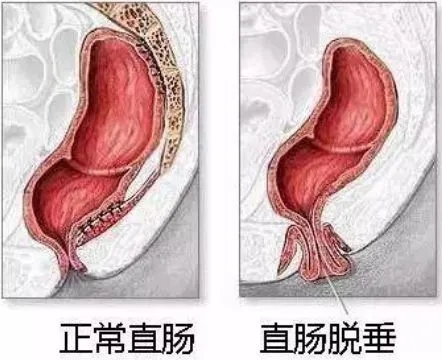 直肠脱垂有哪些症状表现？直肠脱垂的危害有哪些？