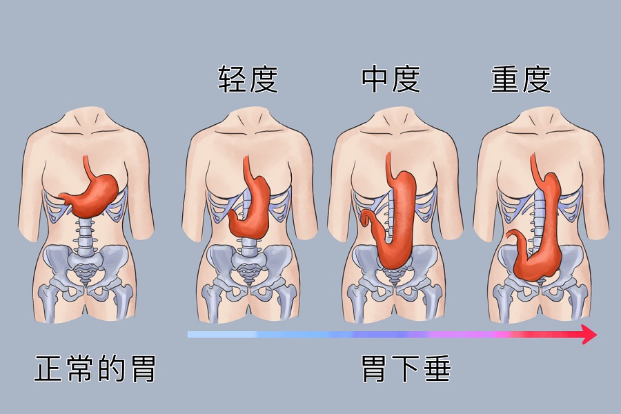 出现这些症状需要提高警惕，有可能是胃下垂的表现！