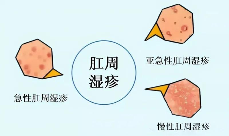 北京治肛周湿疹哪家医院好？肛周湿疹怎么治疗？