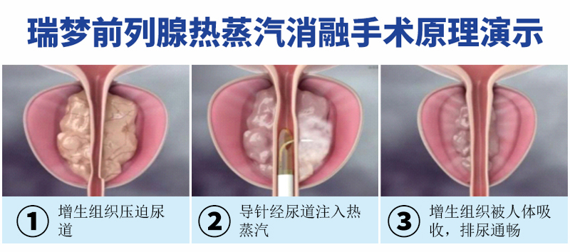 保山前列腺增生治疗：瑞梦热蒸汽消融术，微创不痛，无需住院