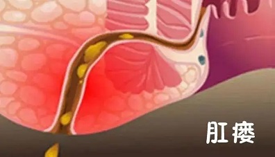 北京做肛瘘手术哪家医院好？肛周脓肿引起的肛瘘应注意什么？
