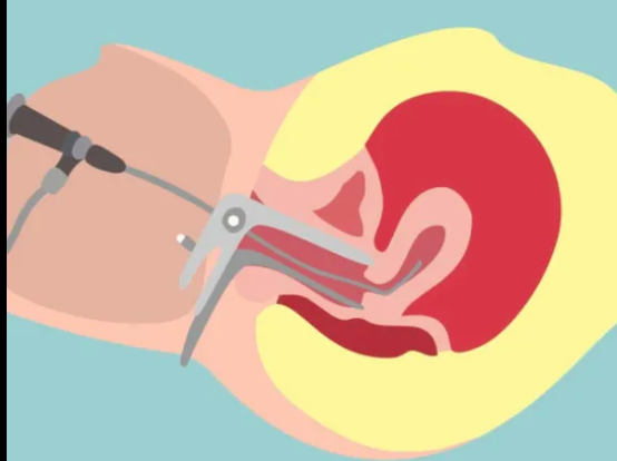 做宫腔镜对身体有伤害吗