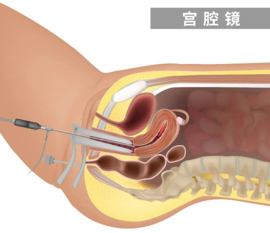 做个宫腔镜多少钱