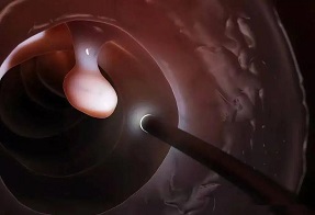 北京2025年度肠癌早筛秋季 身体出现这4个异常，说明结肠息肉来临！