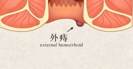 外痔不同于內(nèi)痔和混合痔的地方，都有哪些呢？