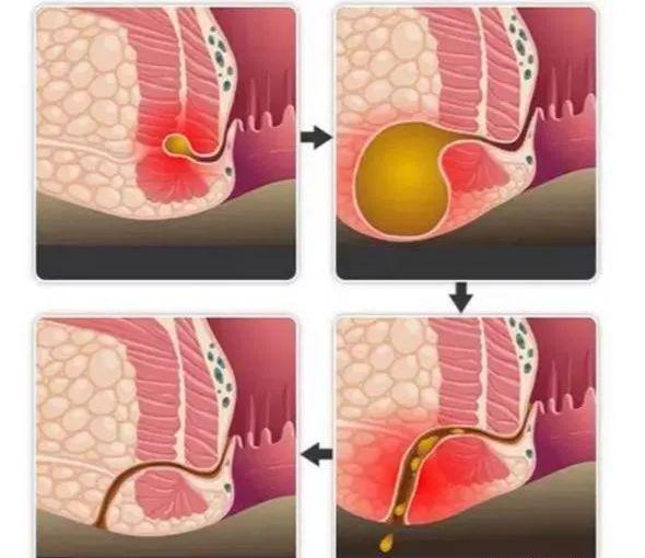 北京做肛周膿腫手術(shù)的醫(yī)院哪家好？肛周膿腫形成肛瘺了，該怎么辦？