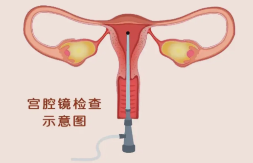 宫腔镜检查疼吗