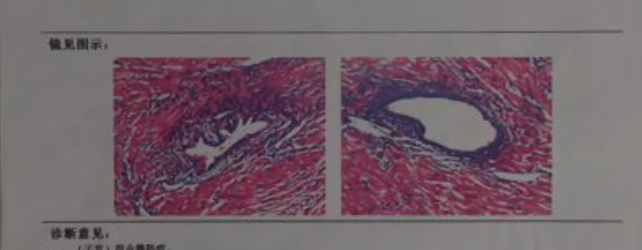 请问什么是子宫腺肌症