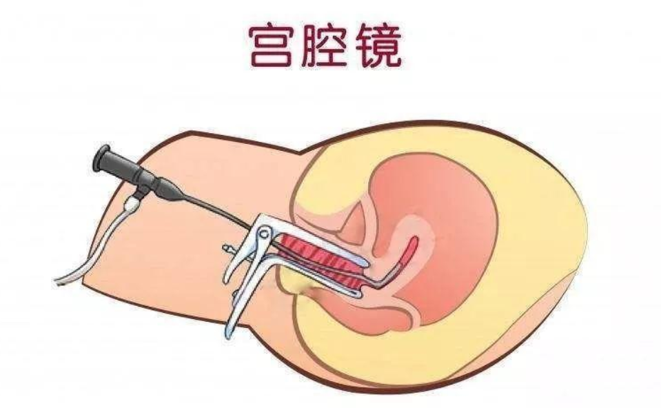 宫腔镜需要住院吗