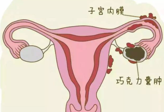 子宫内膜异位需要手术吗