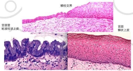 宫颈专业别鳞状上皮内病变