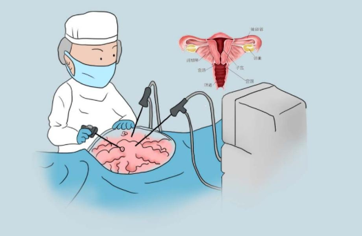 子宫切除是大手术还是小手术