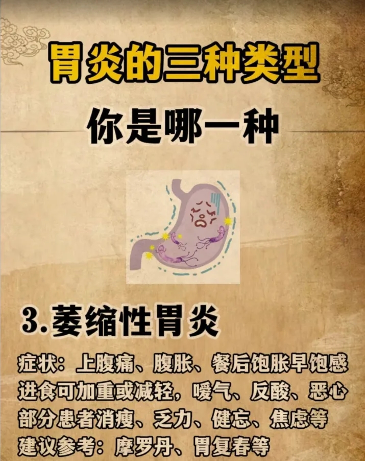 胃炎常见的三种类型，你属于哪一种？我告诉你怎么治！
