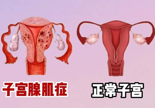 子宫腺肌症出名的医院