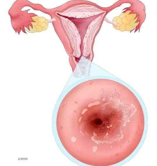 宫颈碘不着色病变几率大吗