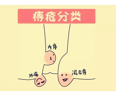 北京治痔疮的医院哪家好？如何判断内痔的严重程度？