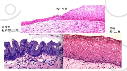 宫颈低级别鳞状上皮内病变