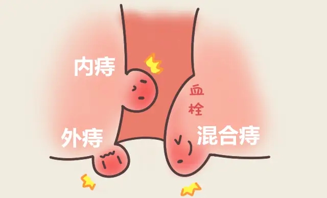 北京治痔瘡好的醫(yī)院是哪家？外痔+內(nèi)痔≠混合痔？