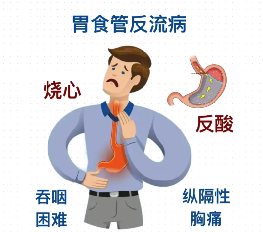 反食管流的症状