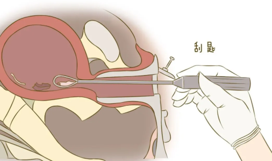子宮內膜診刮術多少錢