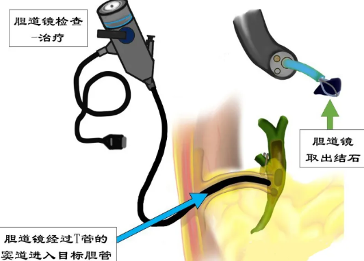 胆道镜检查