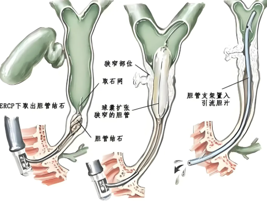 胆管狭窄不治疗可以吗