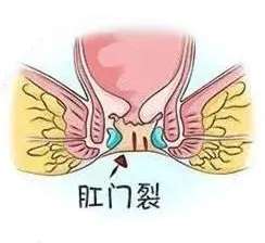北京丰益桥肛肠专科门诊 肛裂三联征是指哪三个？