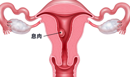 子宮息肉是小手術還是大手術