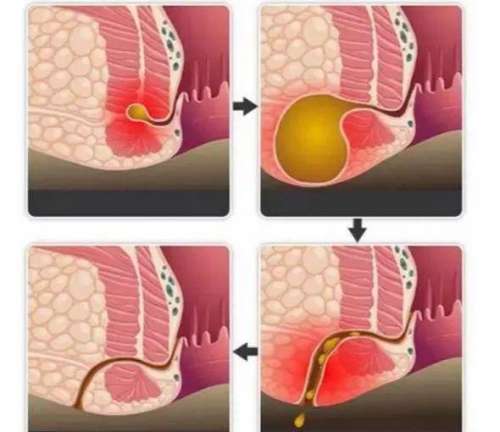治肛瘺北京哪家醫(yī)院好？肛瘺的形成通常會經歷哪幾個階段？