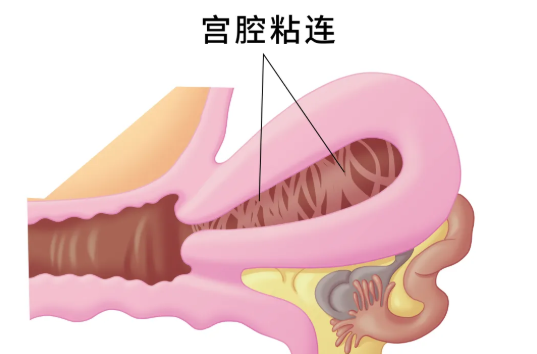 什么情況下要做宮腔鏡