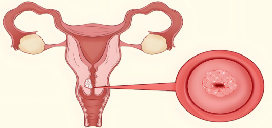 宮頸一級(jí)病變嚴(yán)重嗎?怎么治療