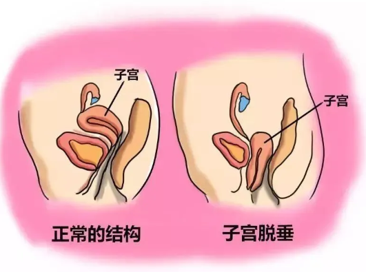 子宮脫垂手術(shù)