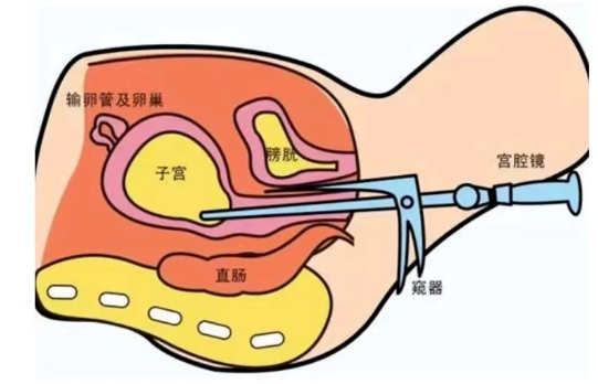 宮腔鏡手術(shù)過程