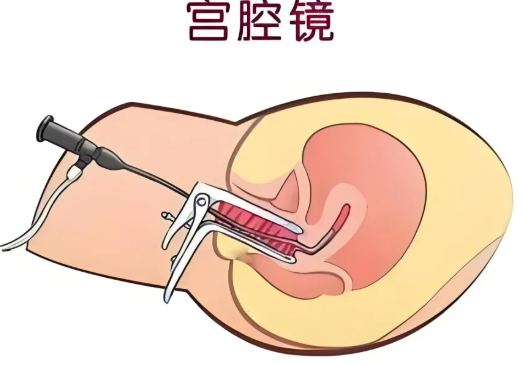 做宮腔鏡檢查需要住院嗎