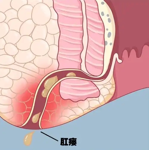 北京做肛瘺手術的醫(yī)院哪家好？肛瘺為什么不能自愈？