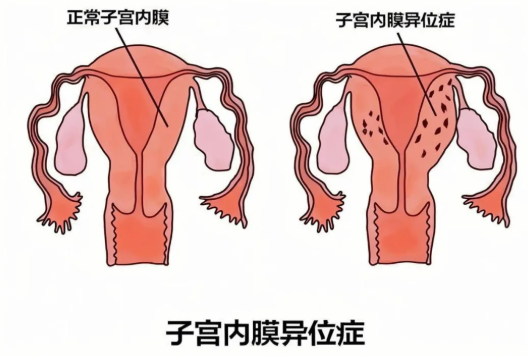 子宮內(nèi)膜移位是什么原因造成的?