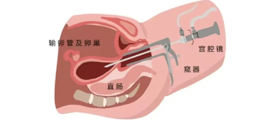 宮腔鏡是什么