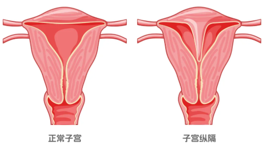 縱隔子宮一定要手術(shù)嗎